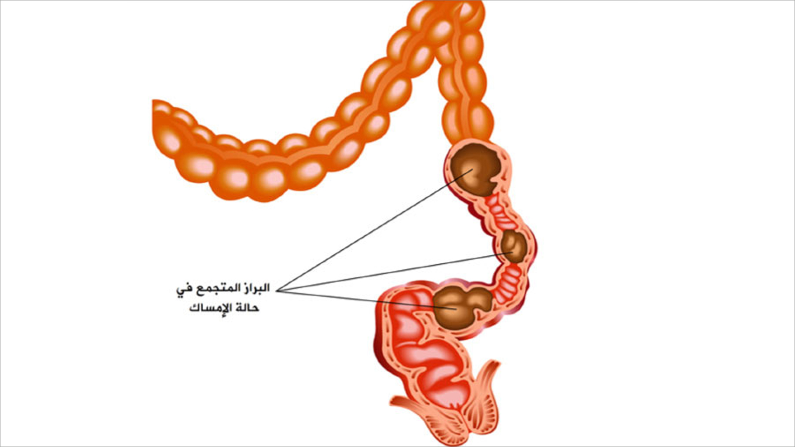 أطعمة تساعد على علاج الإمساك