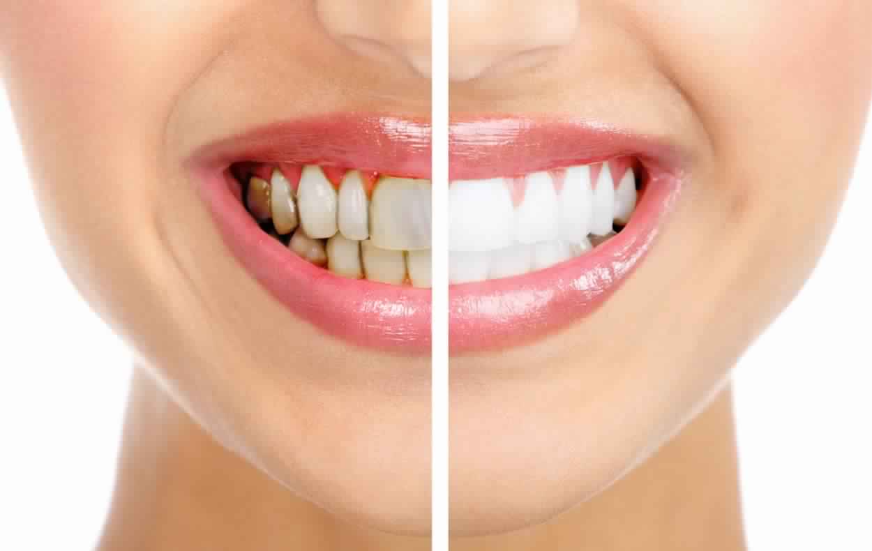 هذه العلاجات تخلّصكم من تورّم اللثة